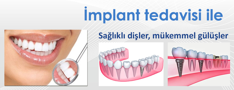 diş-implant